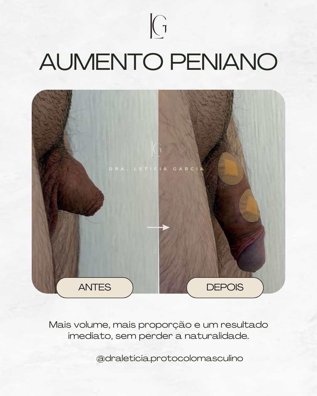 AUMENTO PENIANO (5)