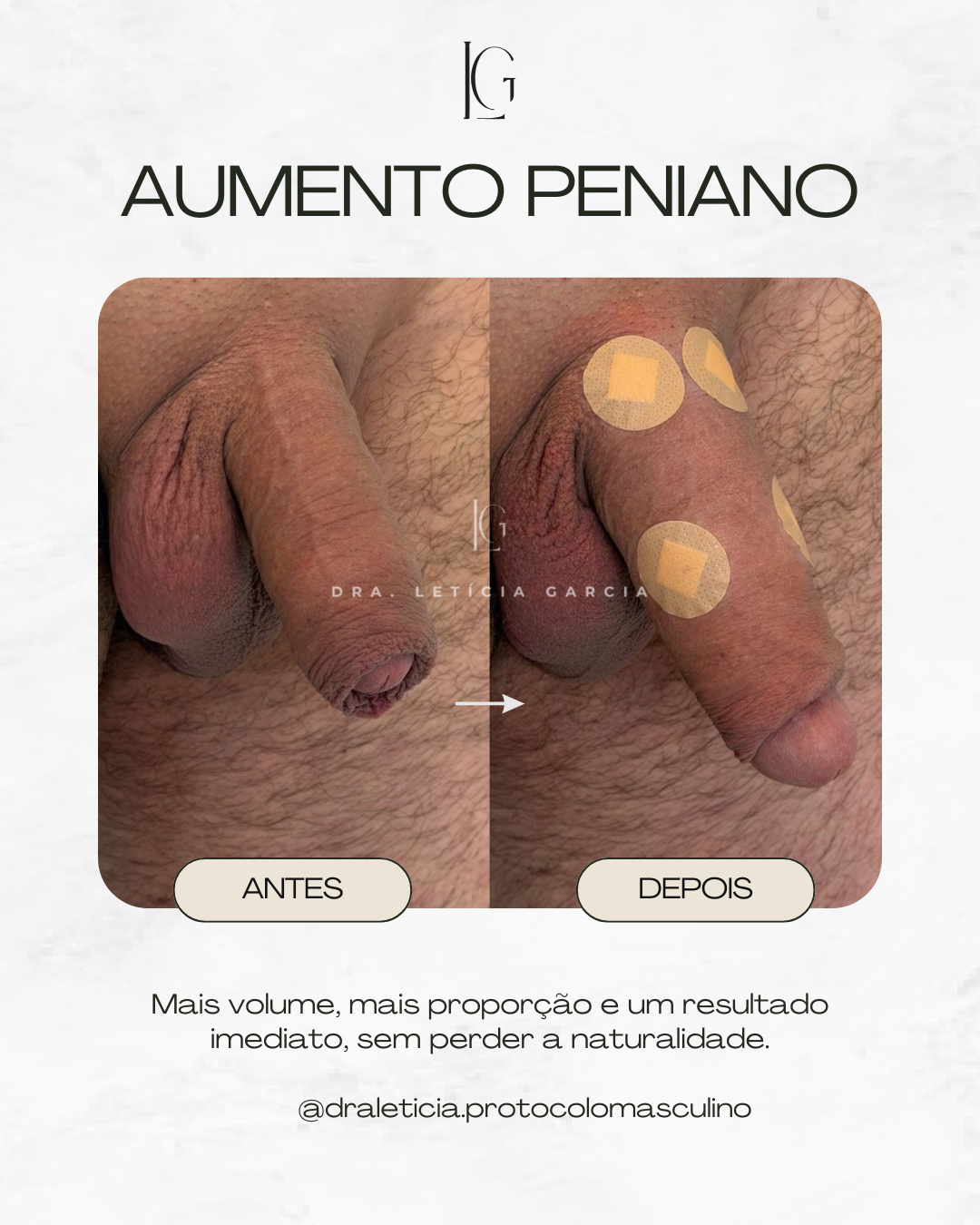 AUMENTO PENIANO (7)